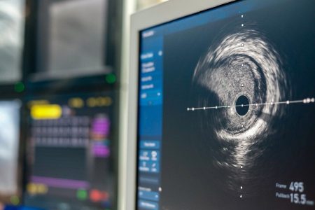 arterial ultrasound